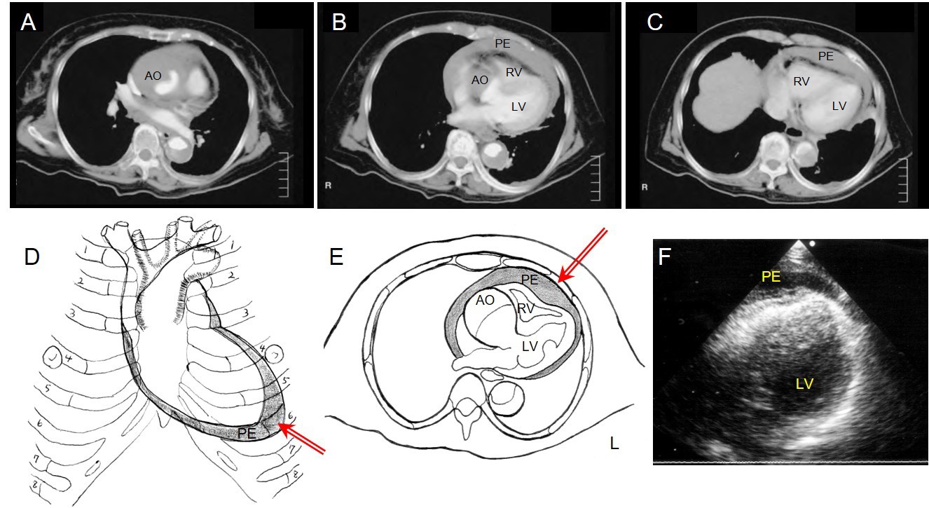 Cardiac Tamponade Due To Aortic Dissection Clinical Picture And Treatment With Focus On